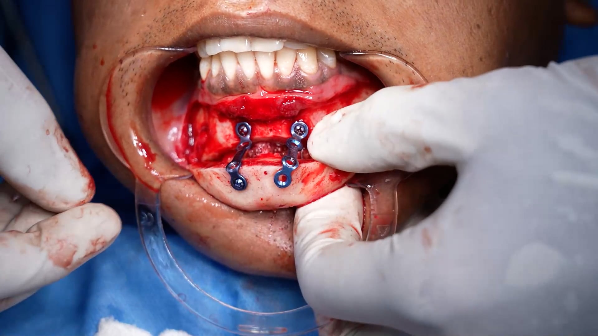 Genioplasty and Jaw sculpting