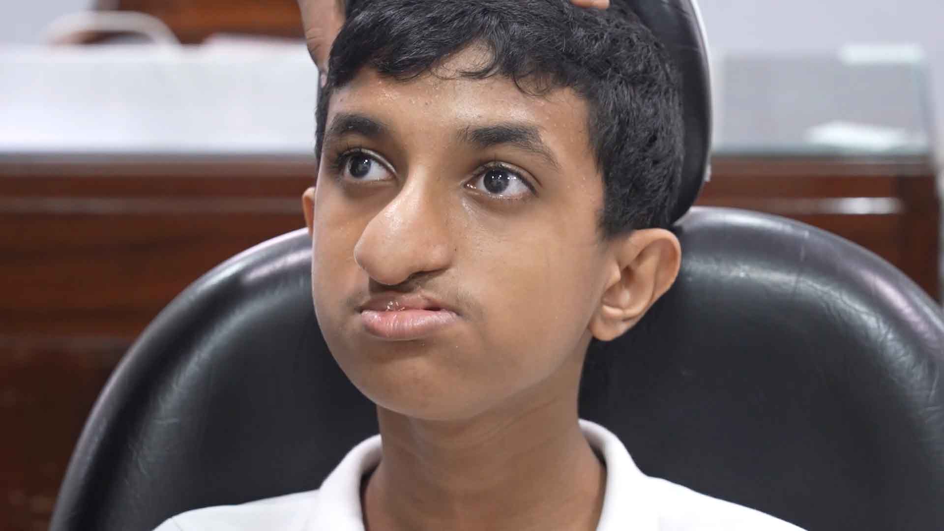 Cleft maxillary hypoplasia- Anterior Maxillary Distraction and Lip revision surgery