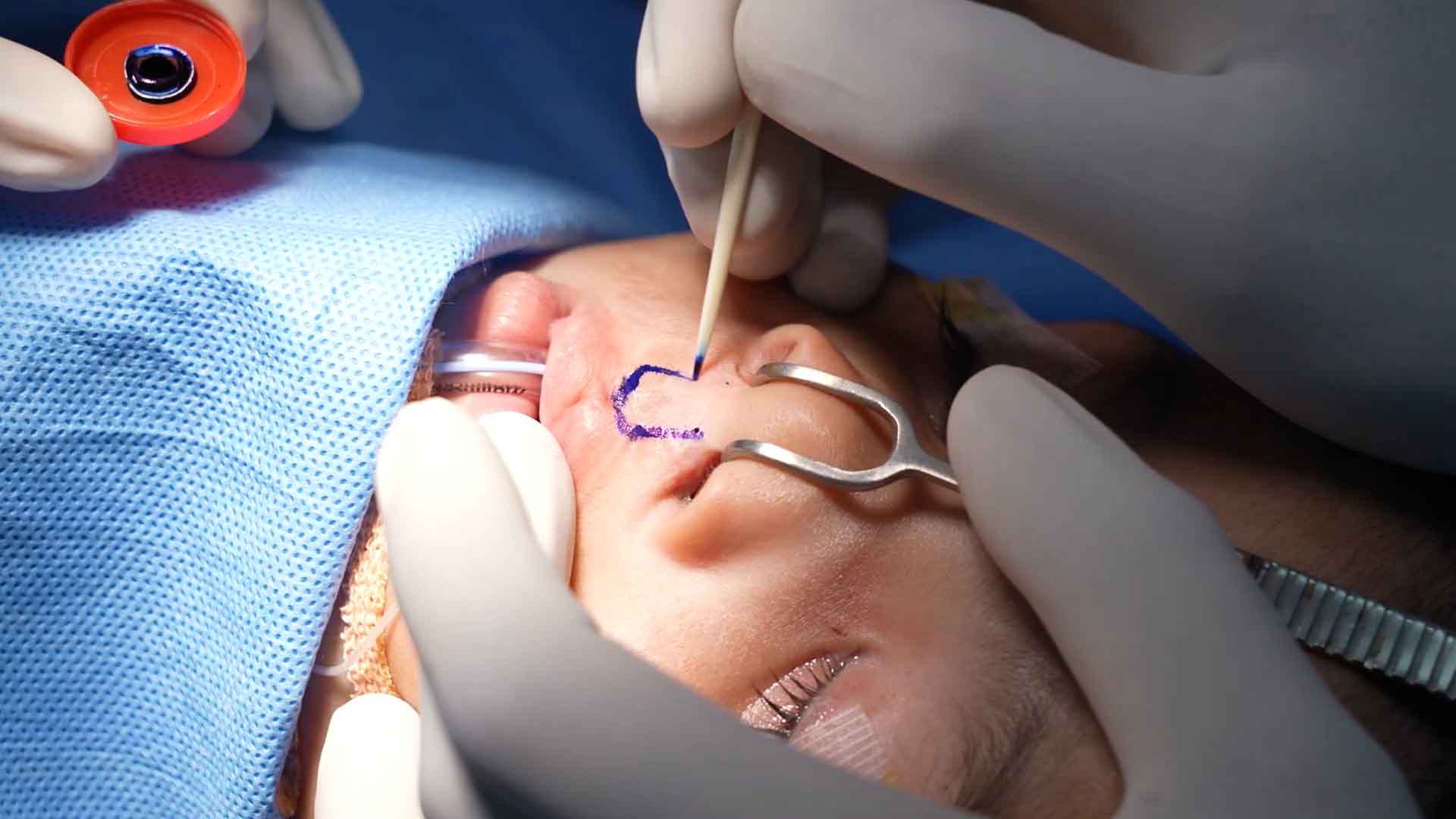 Cleft lip notching repair