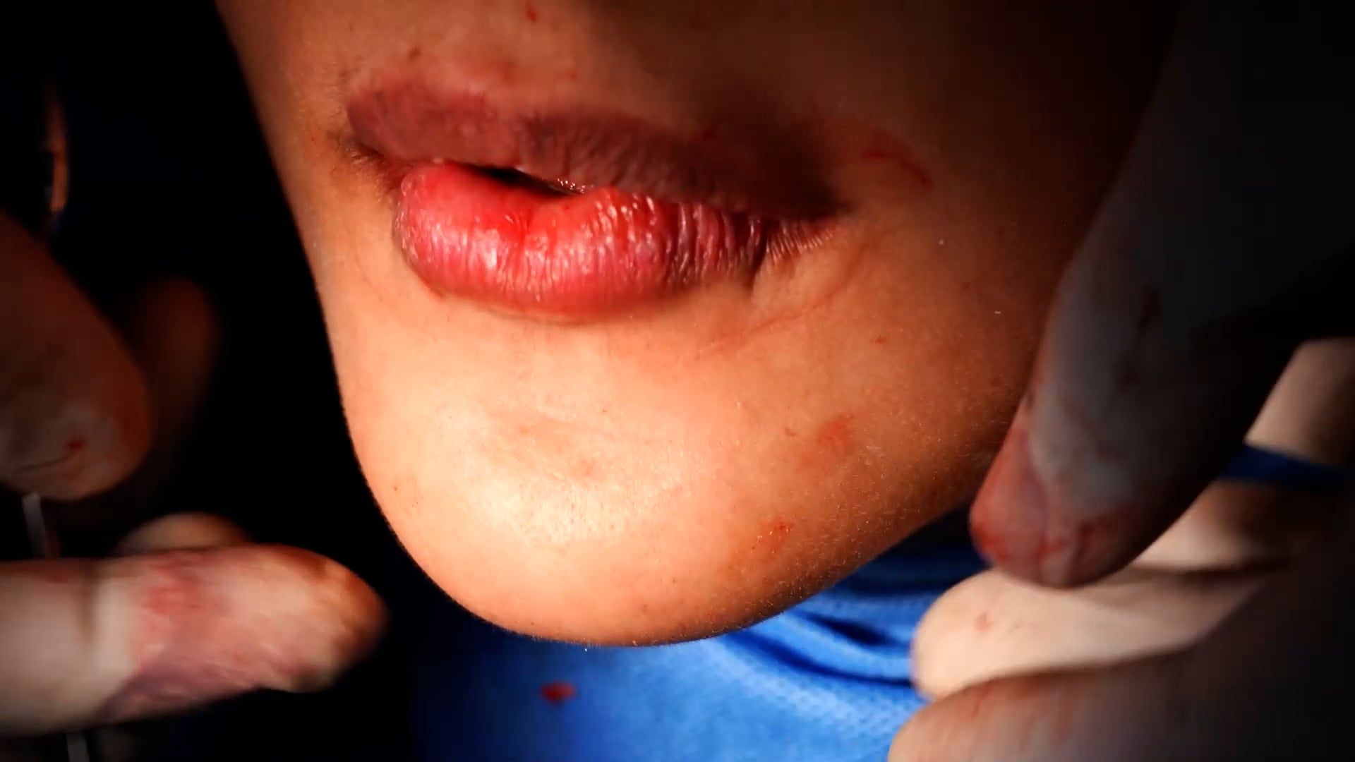 Revision Chin Surgery