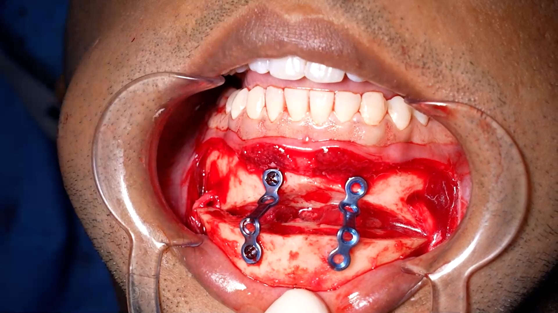 Genioplasty for a male patient with retruded chin