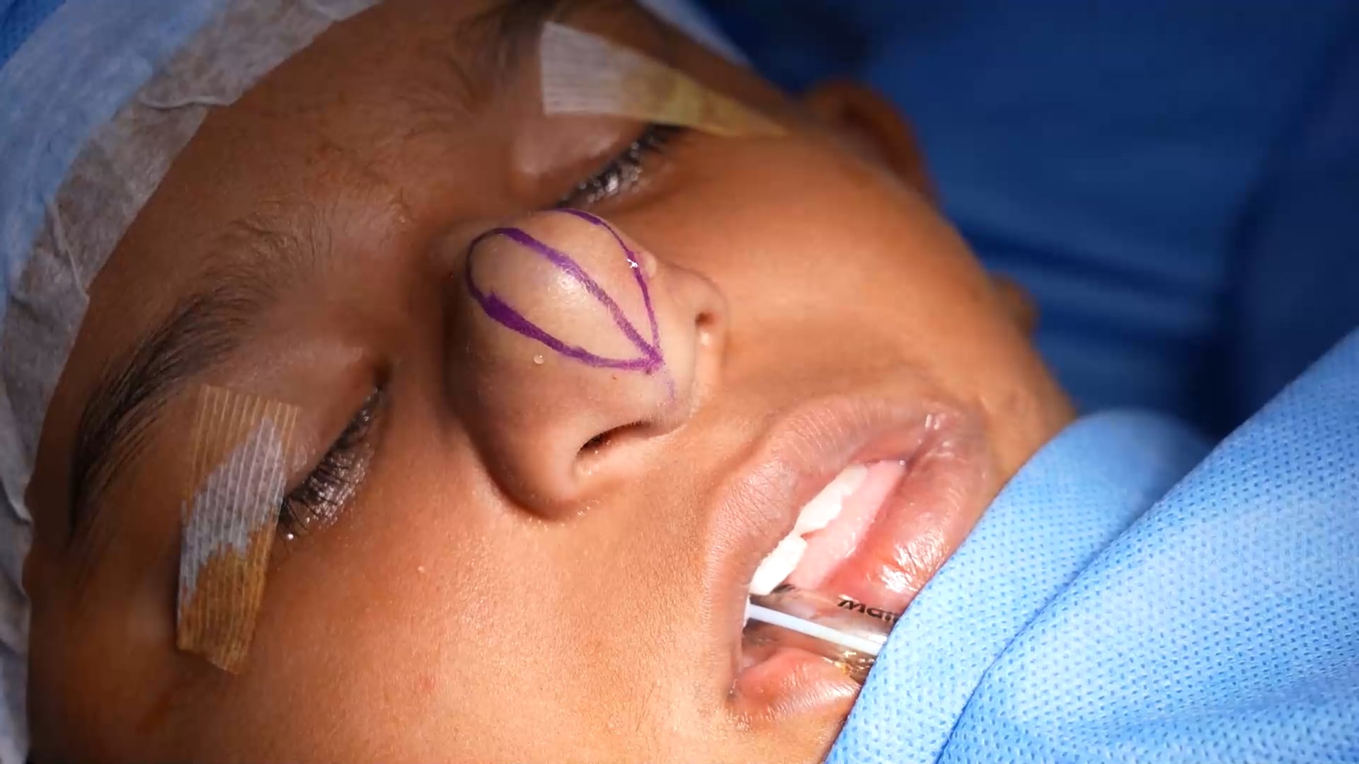 Tumor from Nose Removal