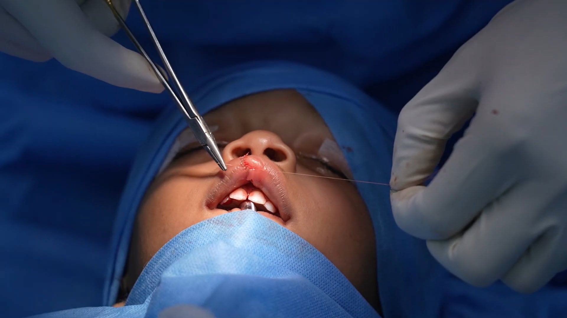 Lip notching correction for a child