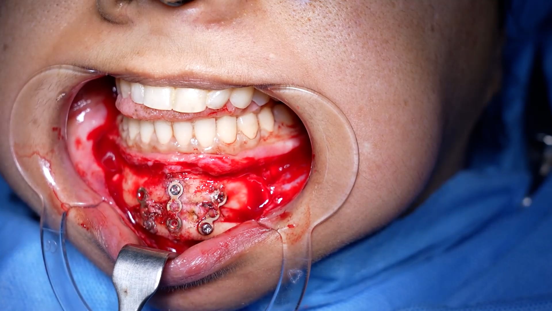 Revision Genioplasty