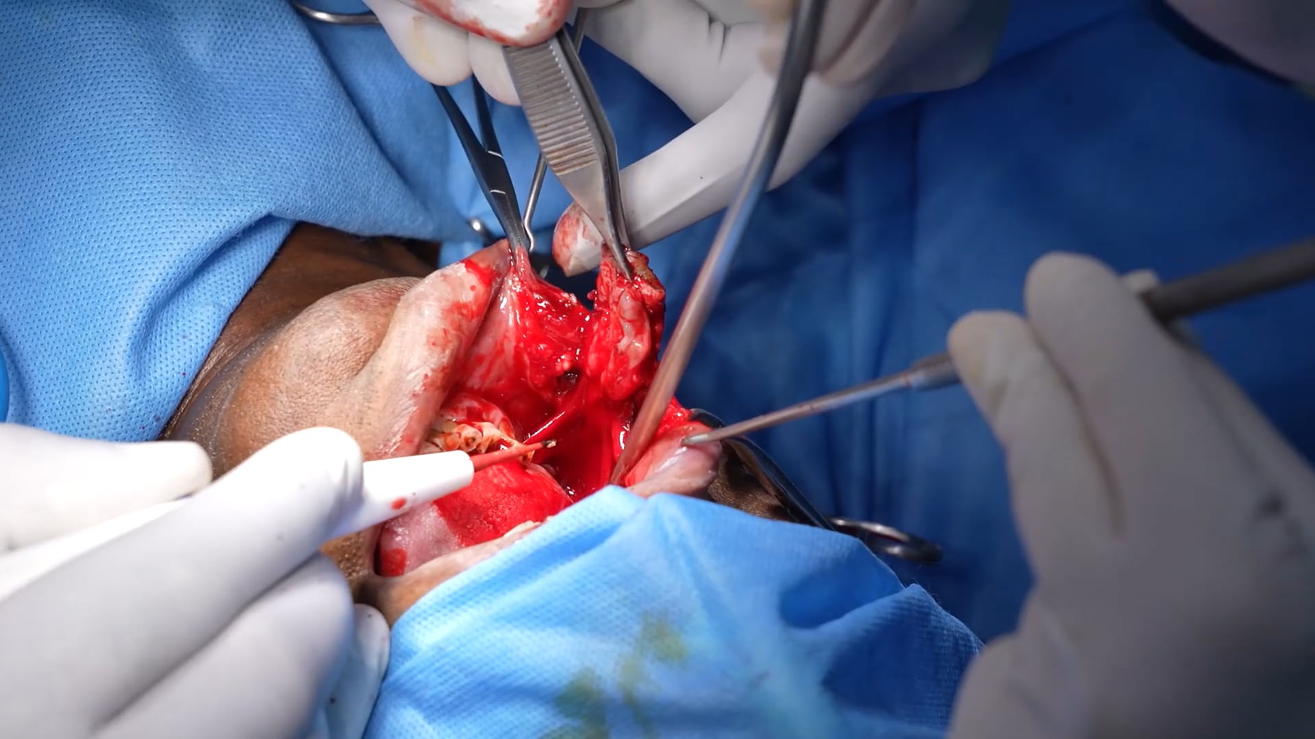 Oral Cancer Surgery