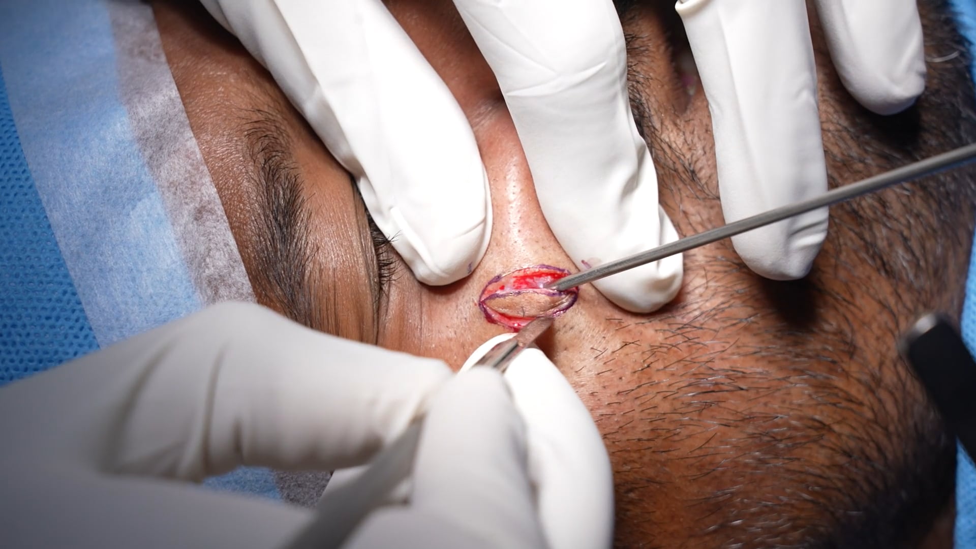 Scar revision Surgery
