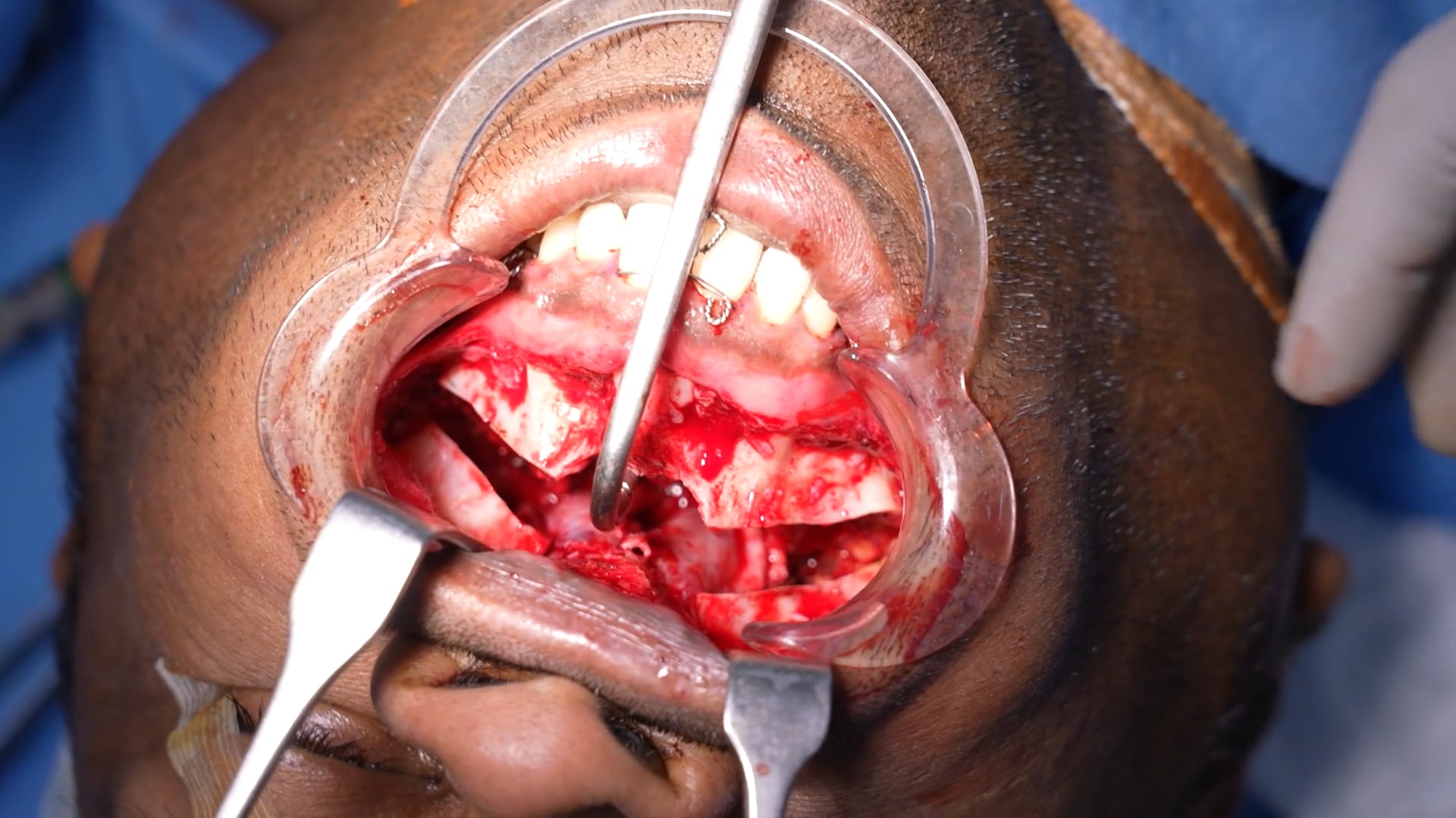 Sleep Apnea Surgery