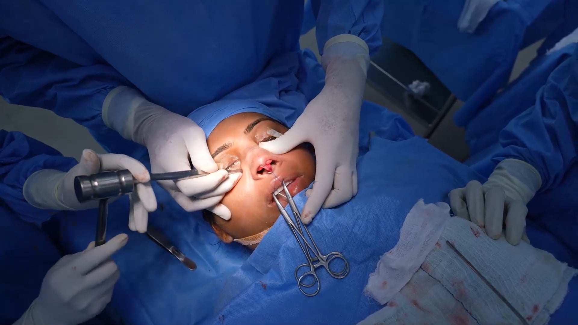 Rhinoplasty Complete Surgery