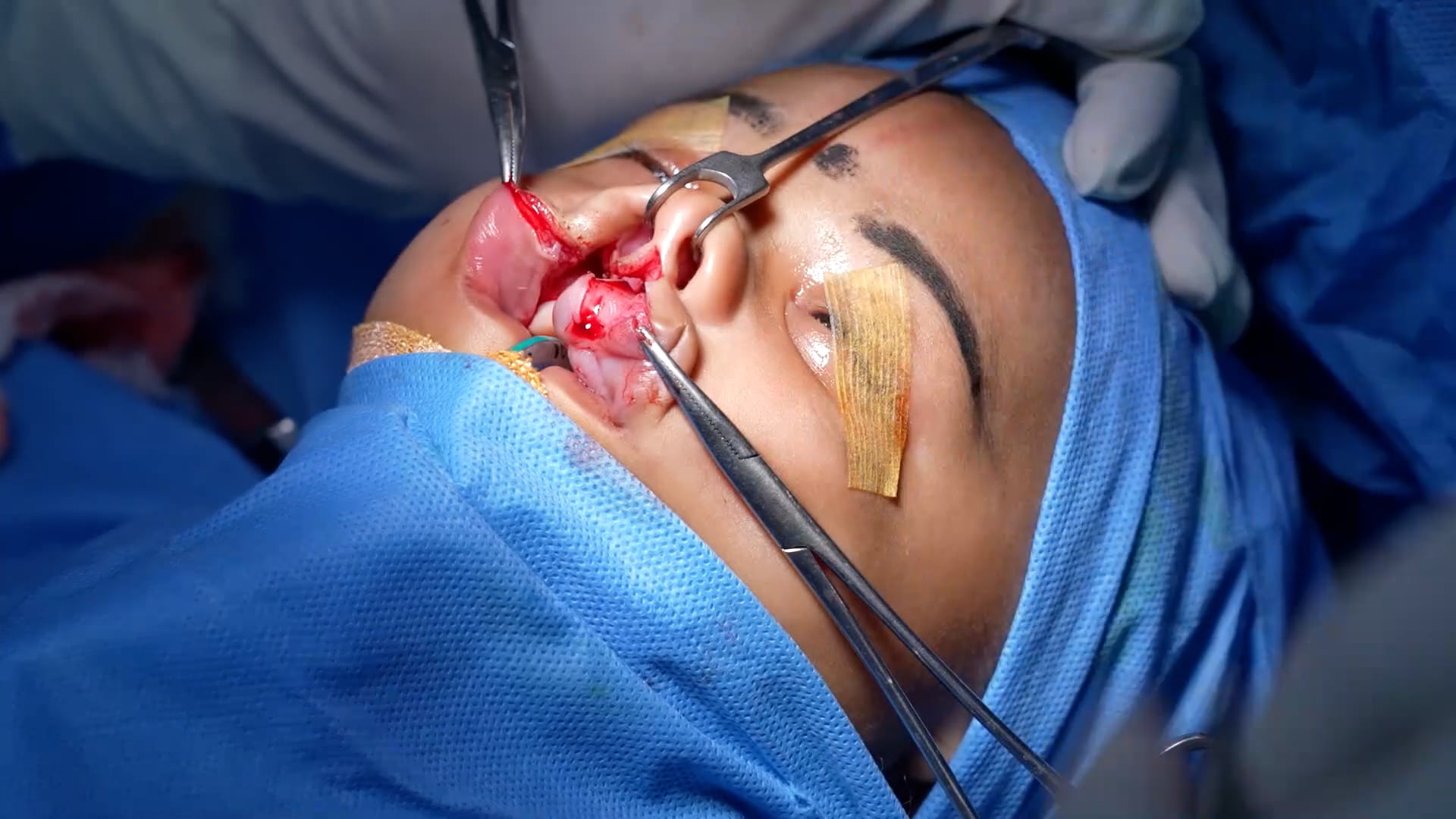 Wide unilateral complete cleft lip repair