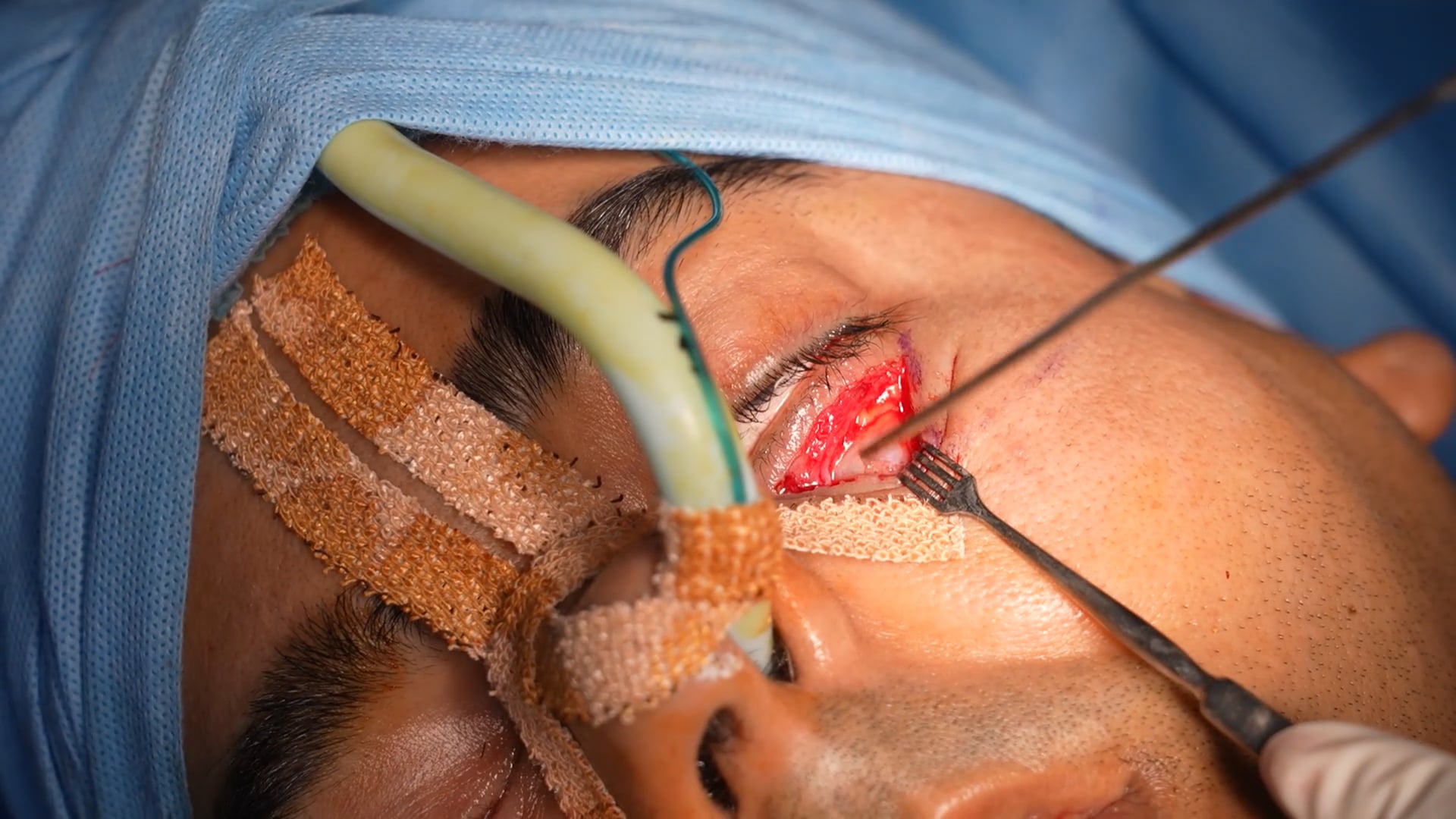 Man Blepharoplasty Surgery