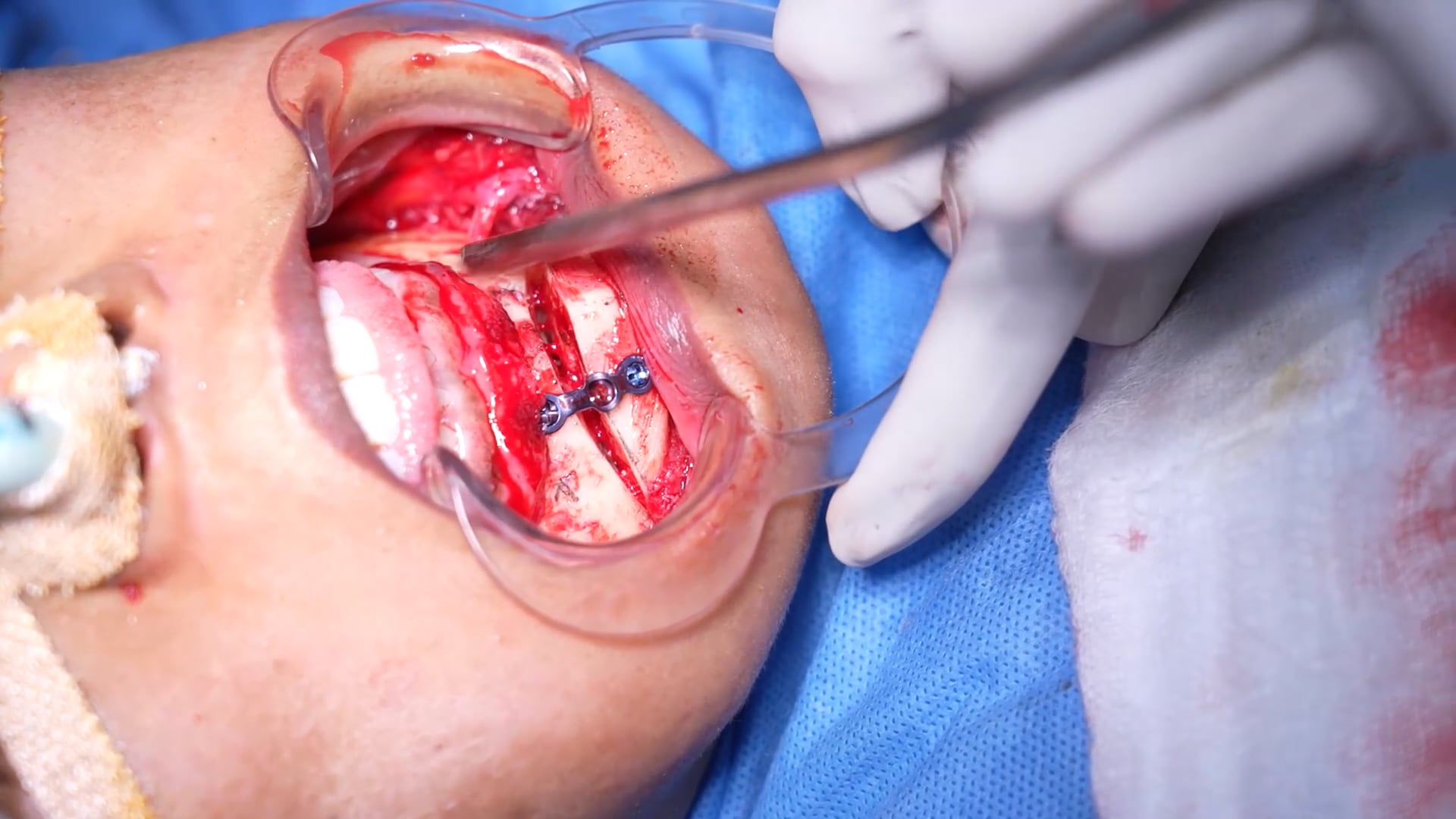 Chin Augmentation Female Surgery