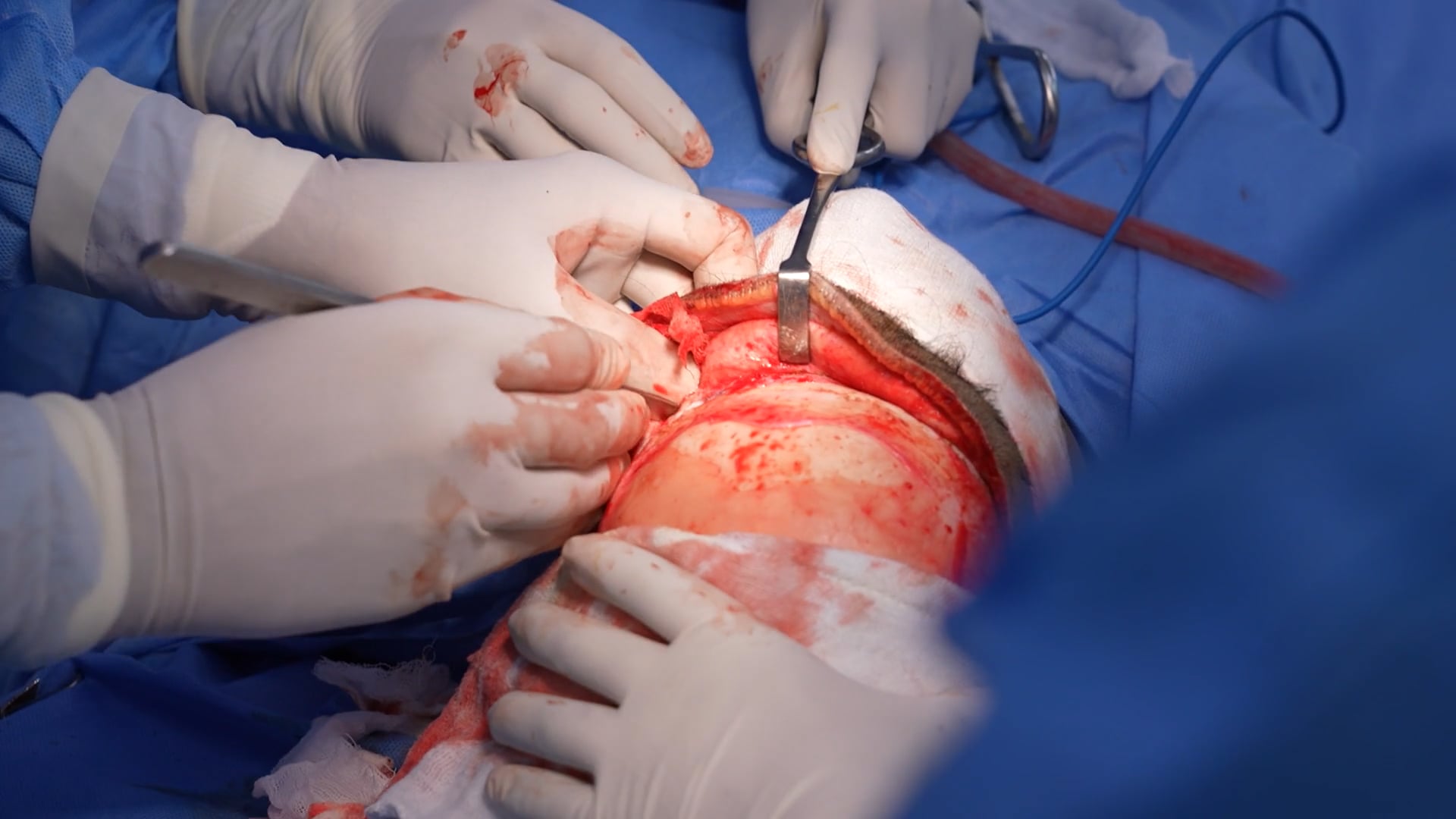 Female Cranio Surgery
