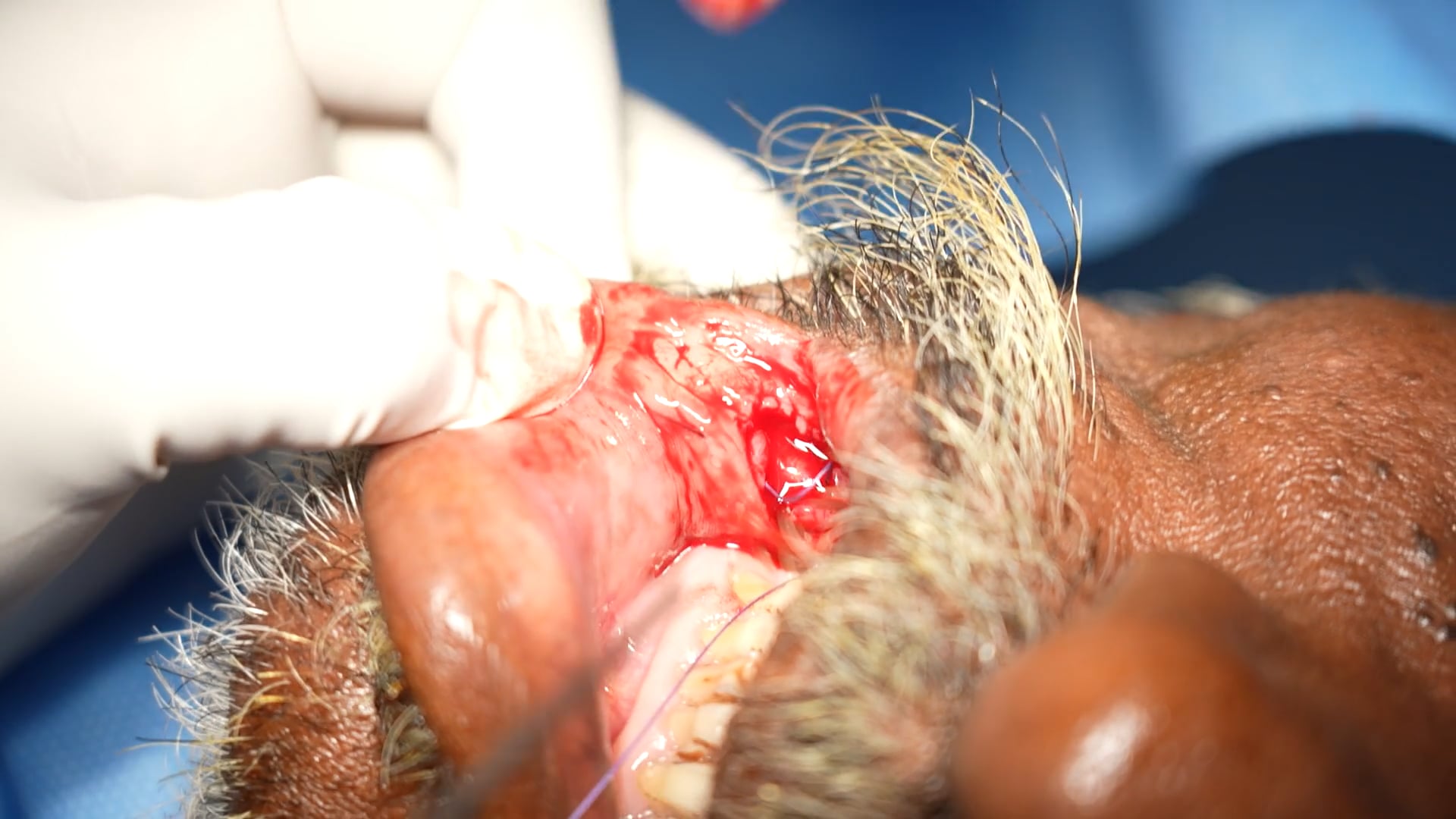 Old Man Cancer biopsy
