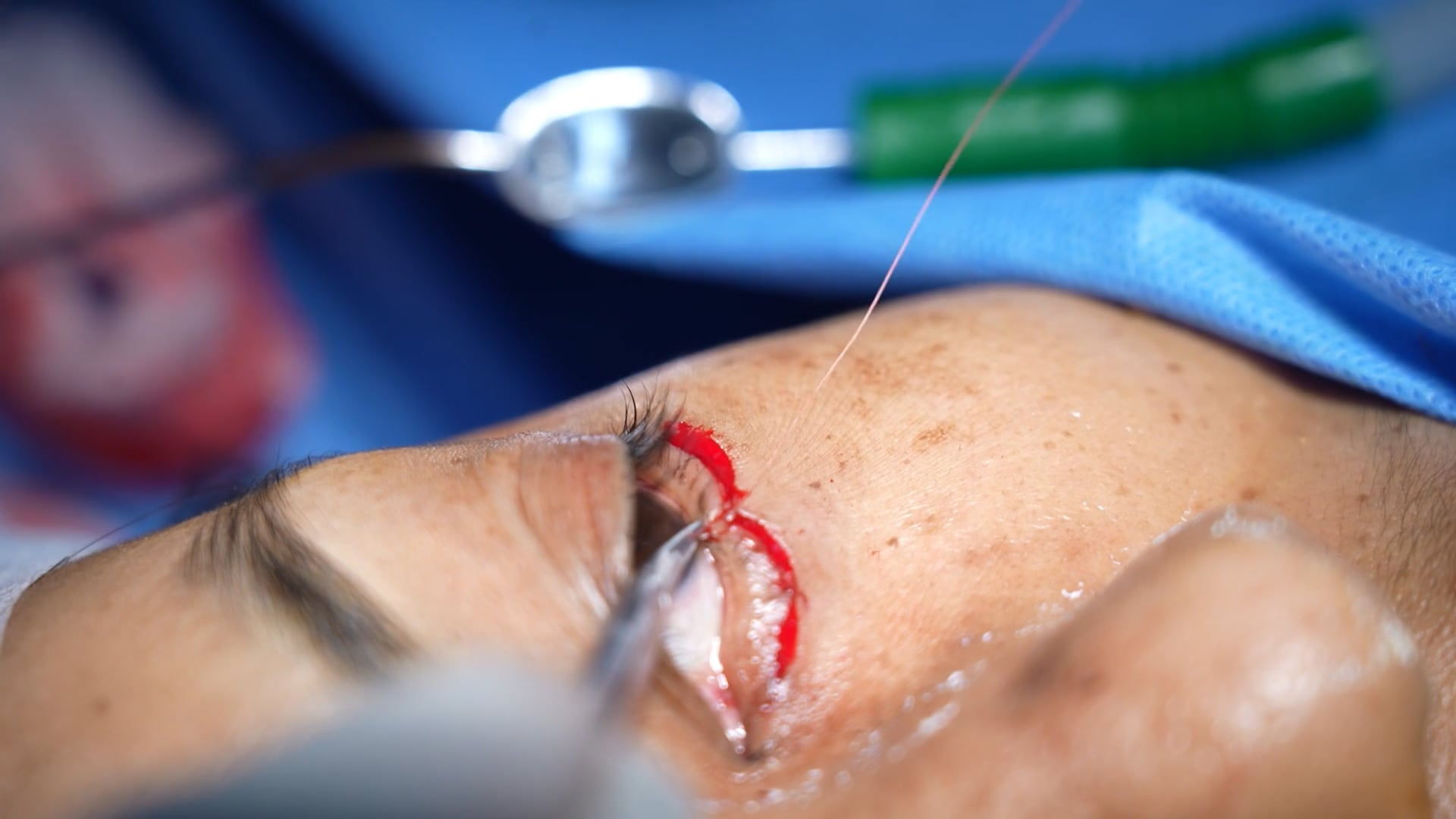 Female Blepharoplasty Surgery