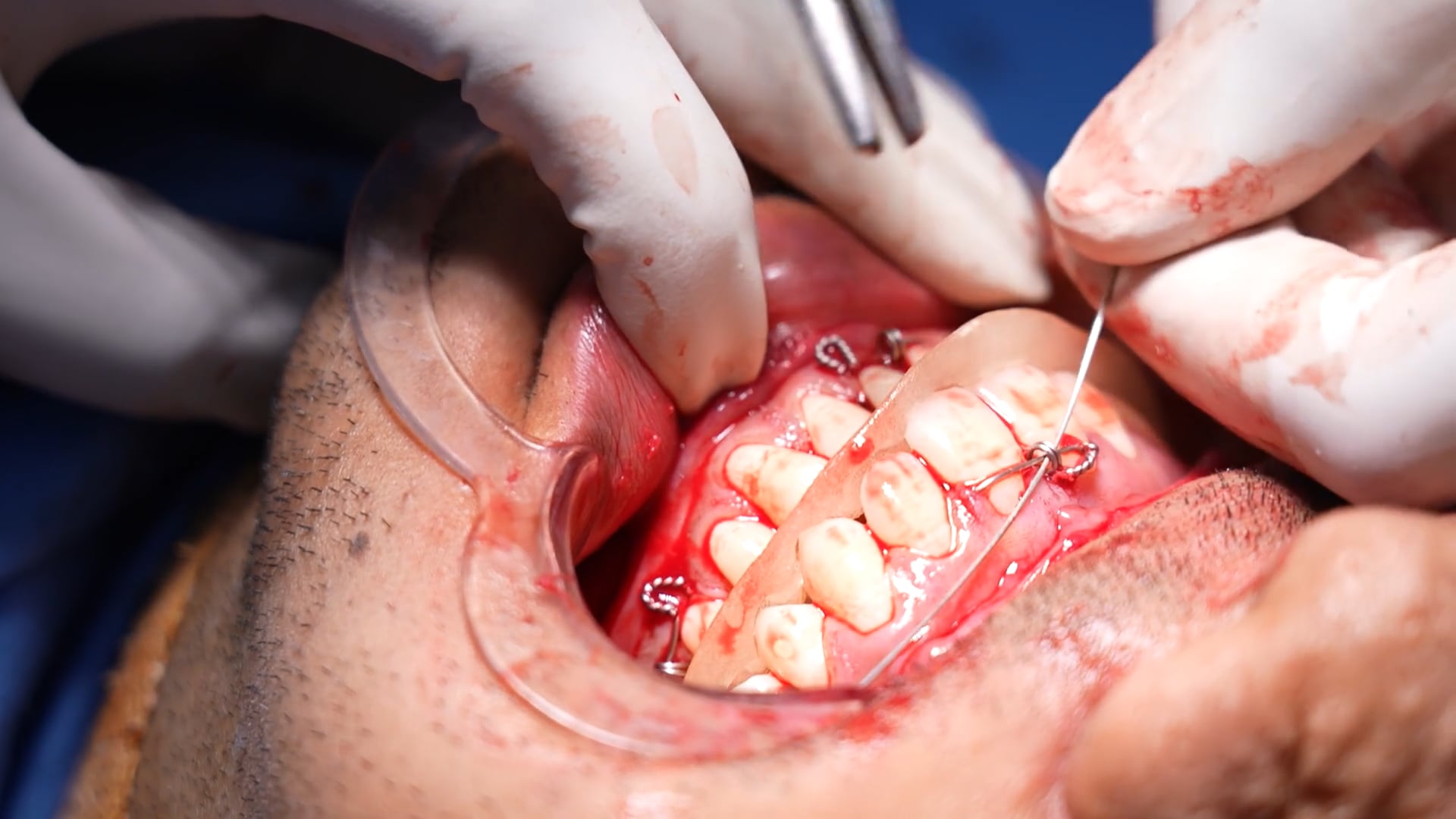 Male Facial Surgery