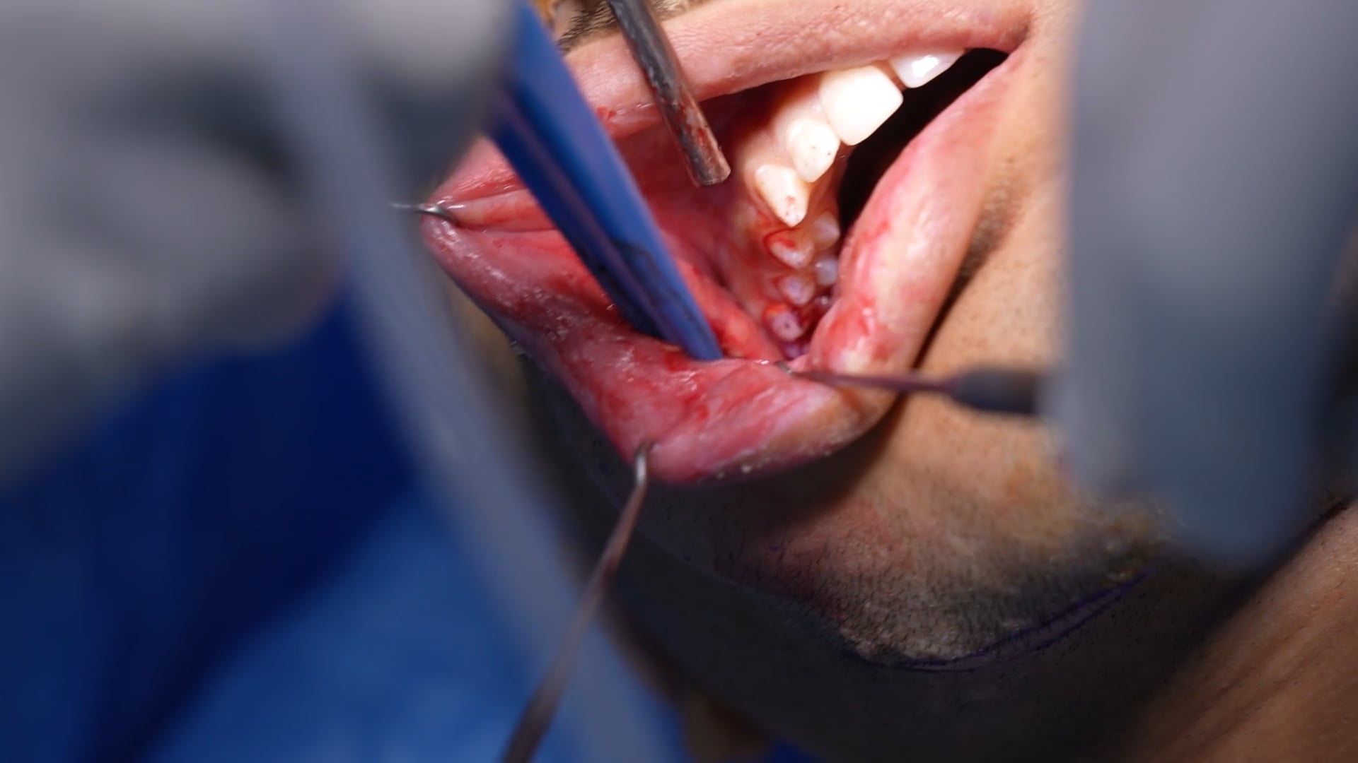 Mouth Hemangioma Surgery