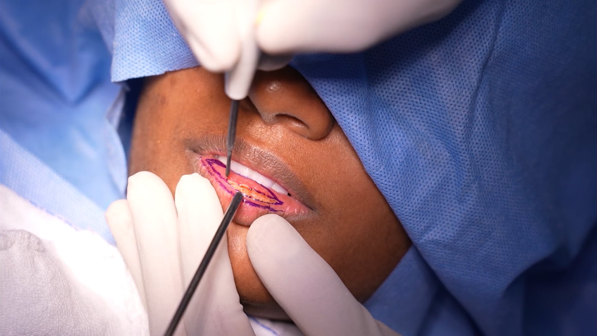 Male Lip Reduction Surgery