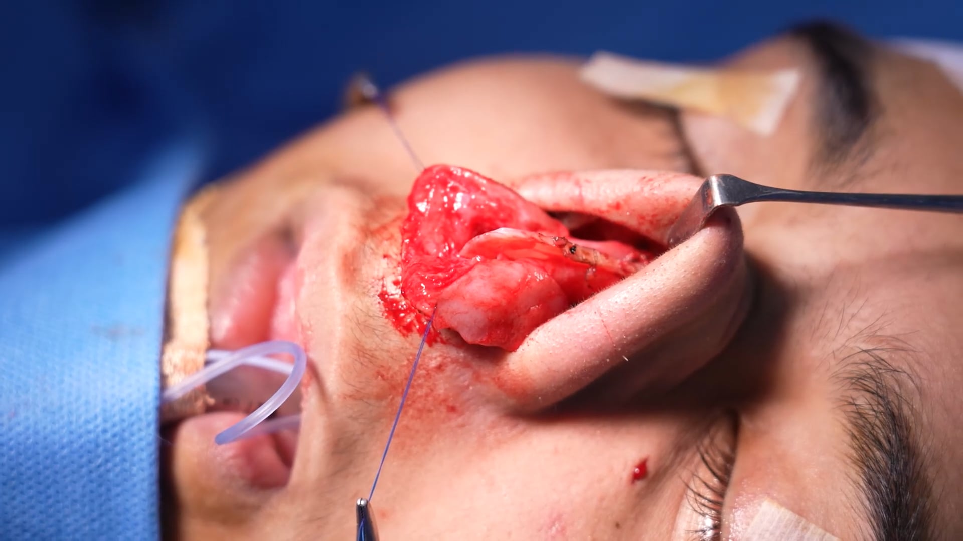 Man Rhinoplasty Surgery