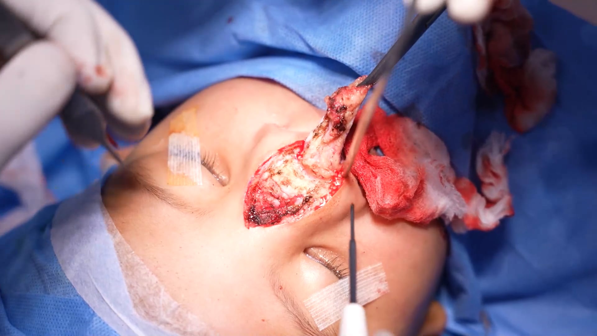 Cute Baby Rare Cleft Nose Surgery