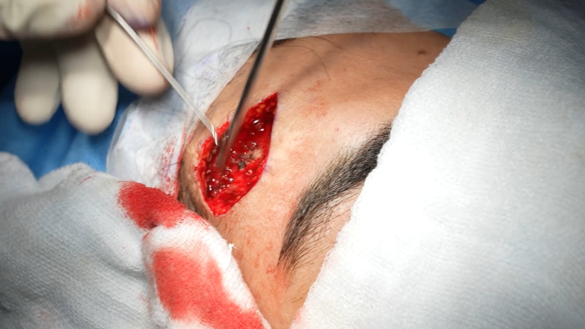 Scar Revision Male Surgey