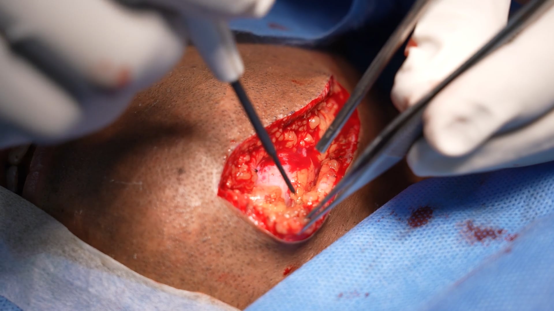 Man going under Scar Revision