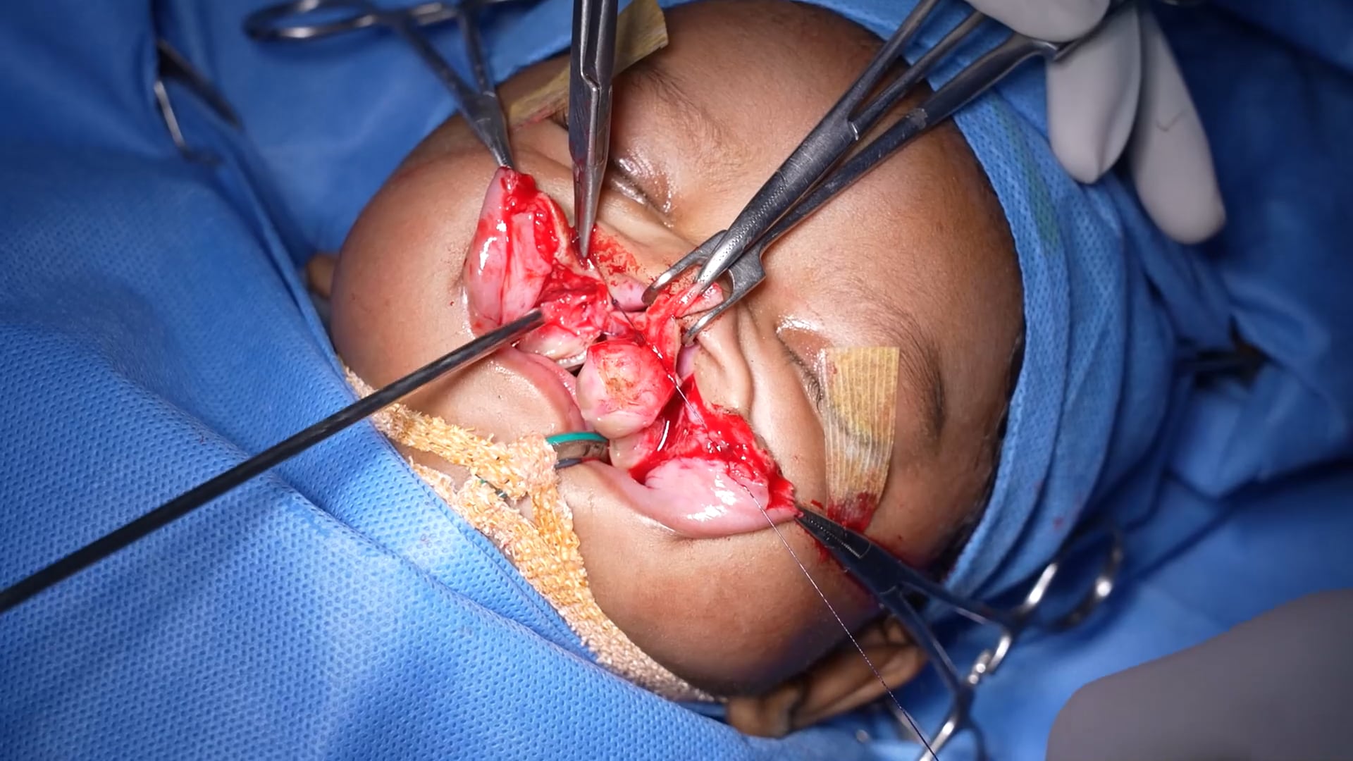 Cleft Lip Baby Surgery