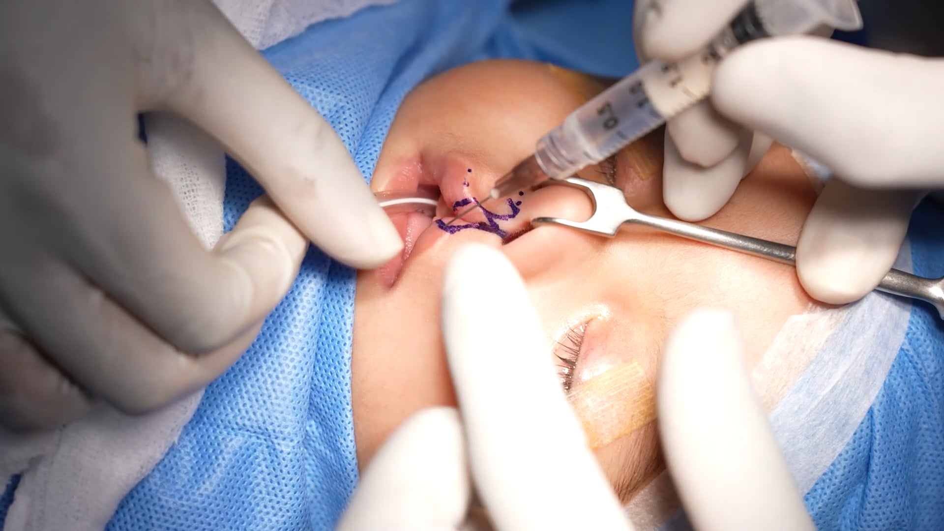 Small Baby Cleft lip Surgery