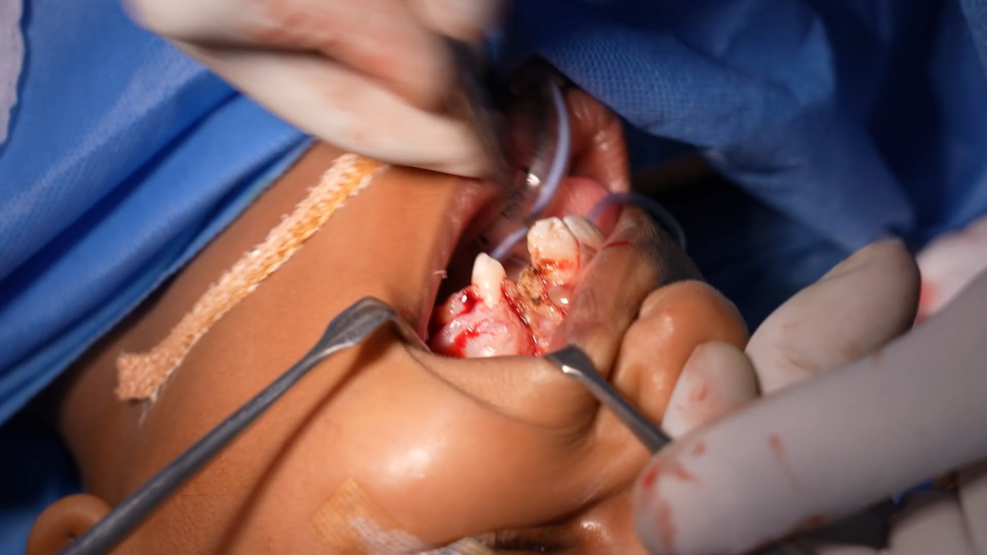 Little Girl Cleft Lip Palate