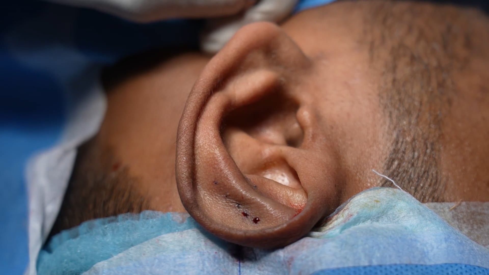 Ear Pinning Surgery