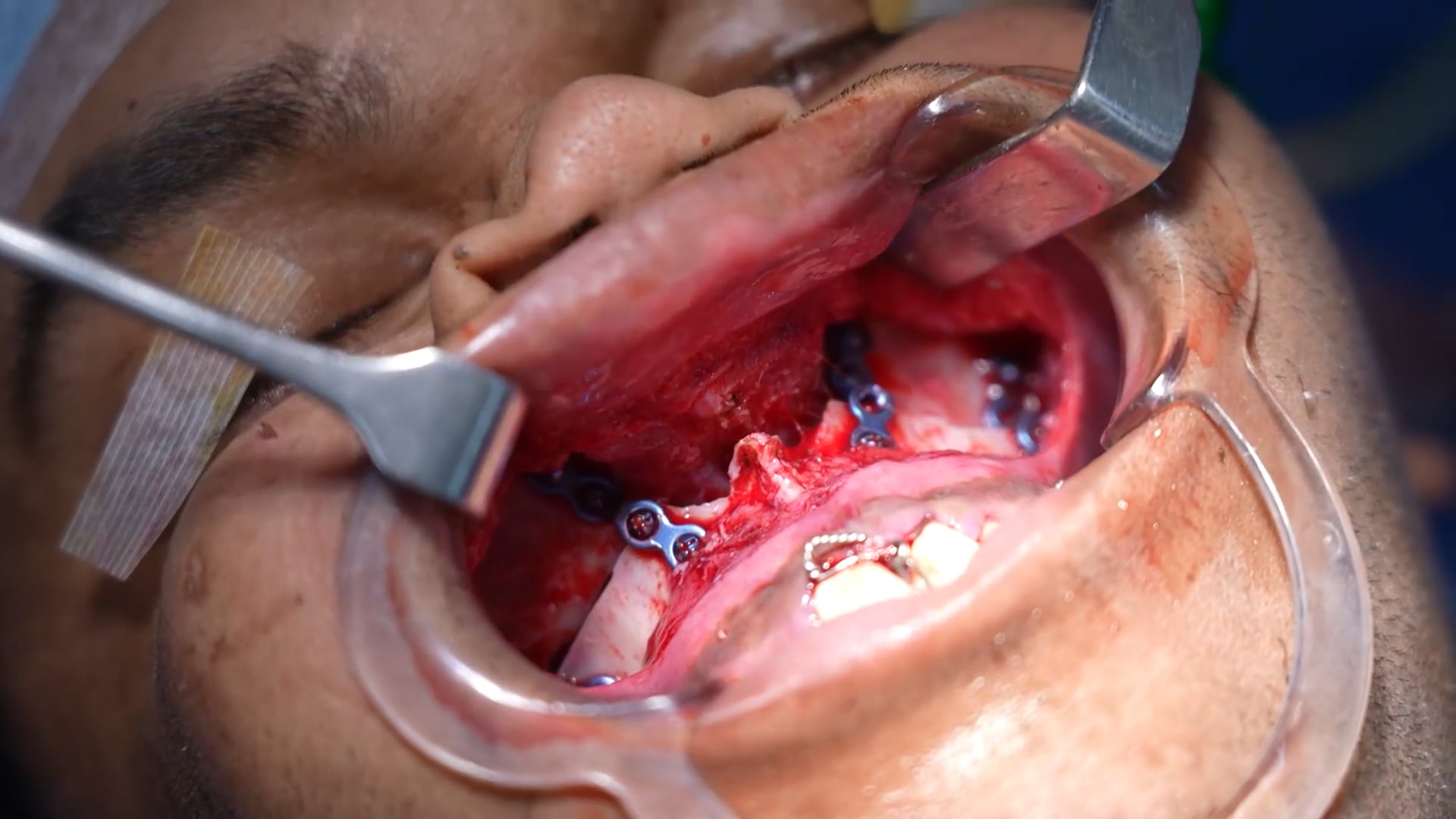 Bijaw Surgery