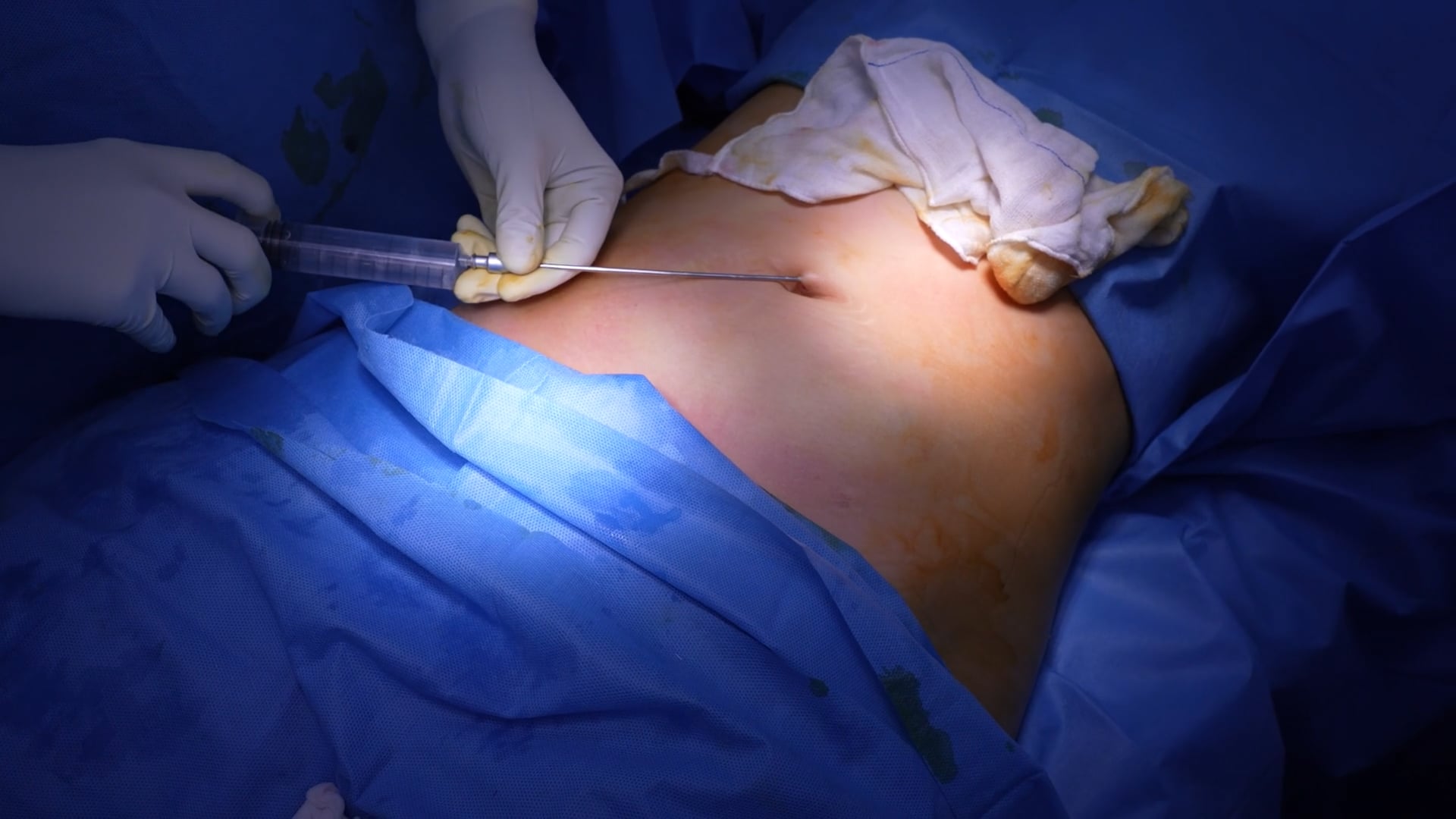Female Liposuction Surgery