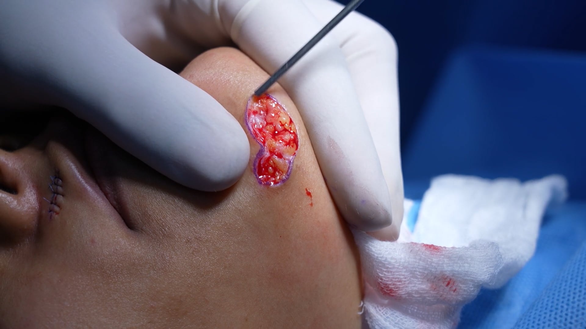 Female Mole Removal Surgery