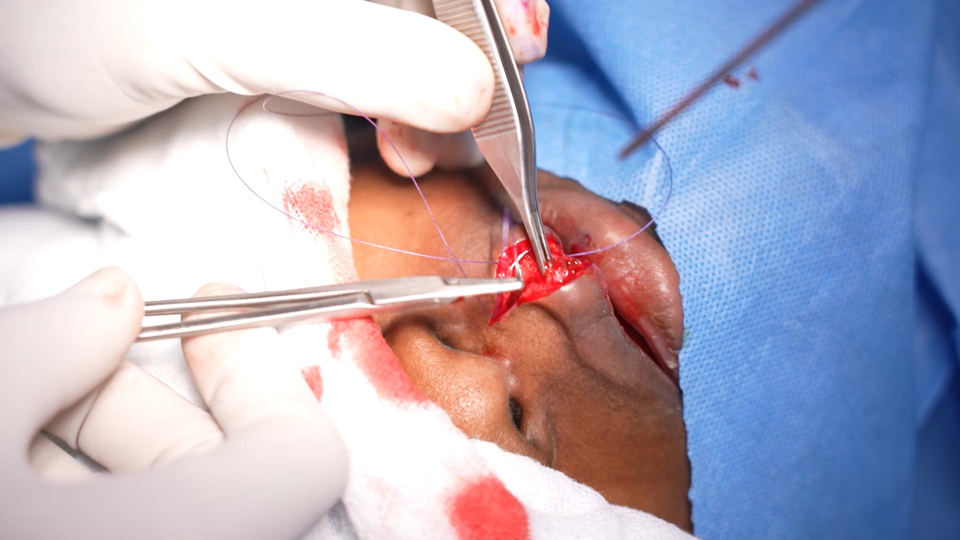 Young Man Lip Reduction Surgery