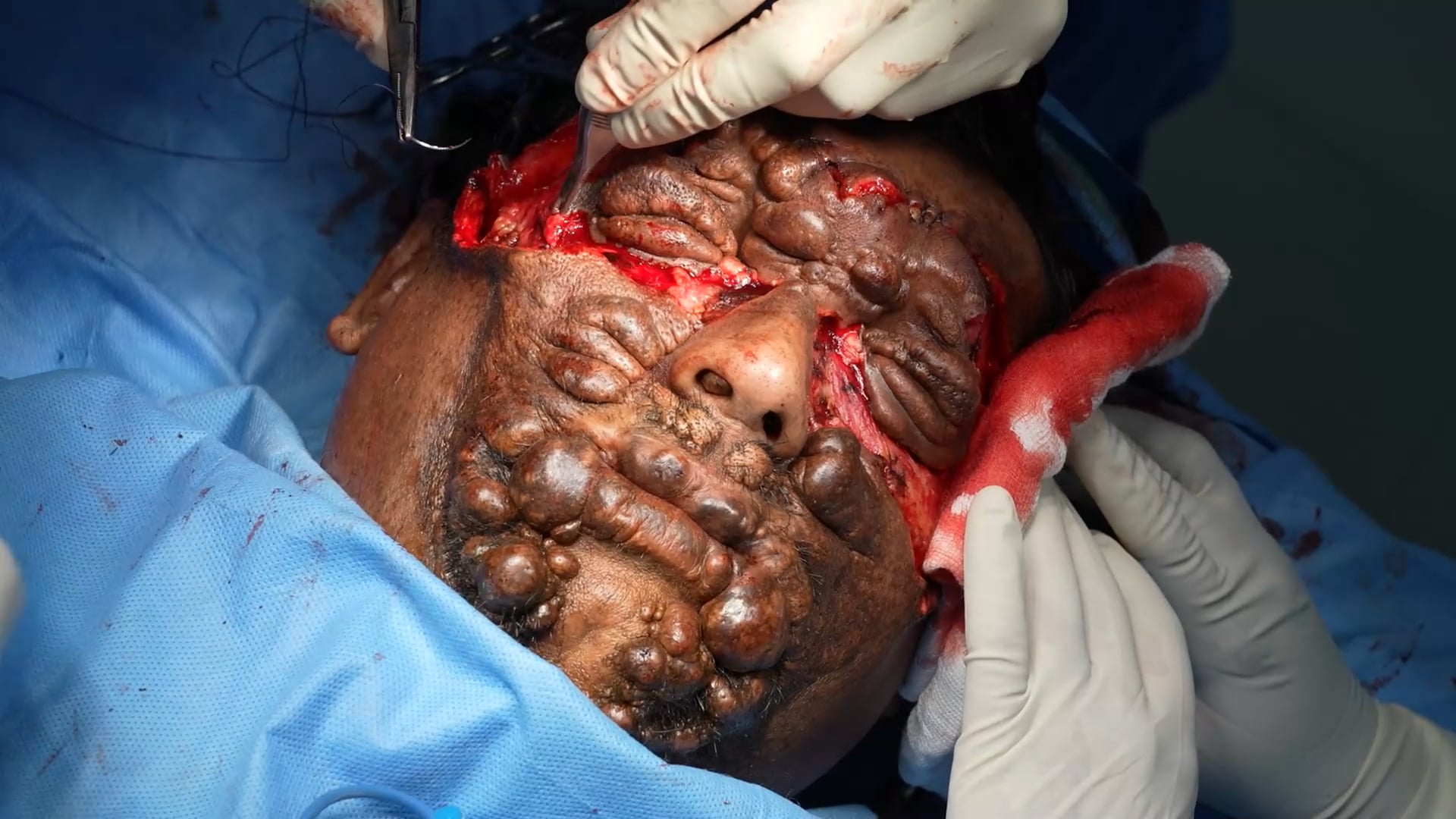 Neurofibroma Tumor Removal